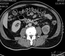 双肾b超在线视频,清晰展现肾脏健康状态
